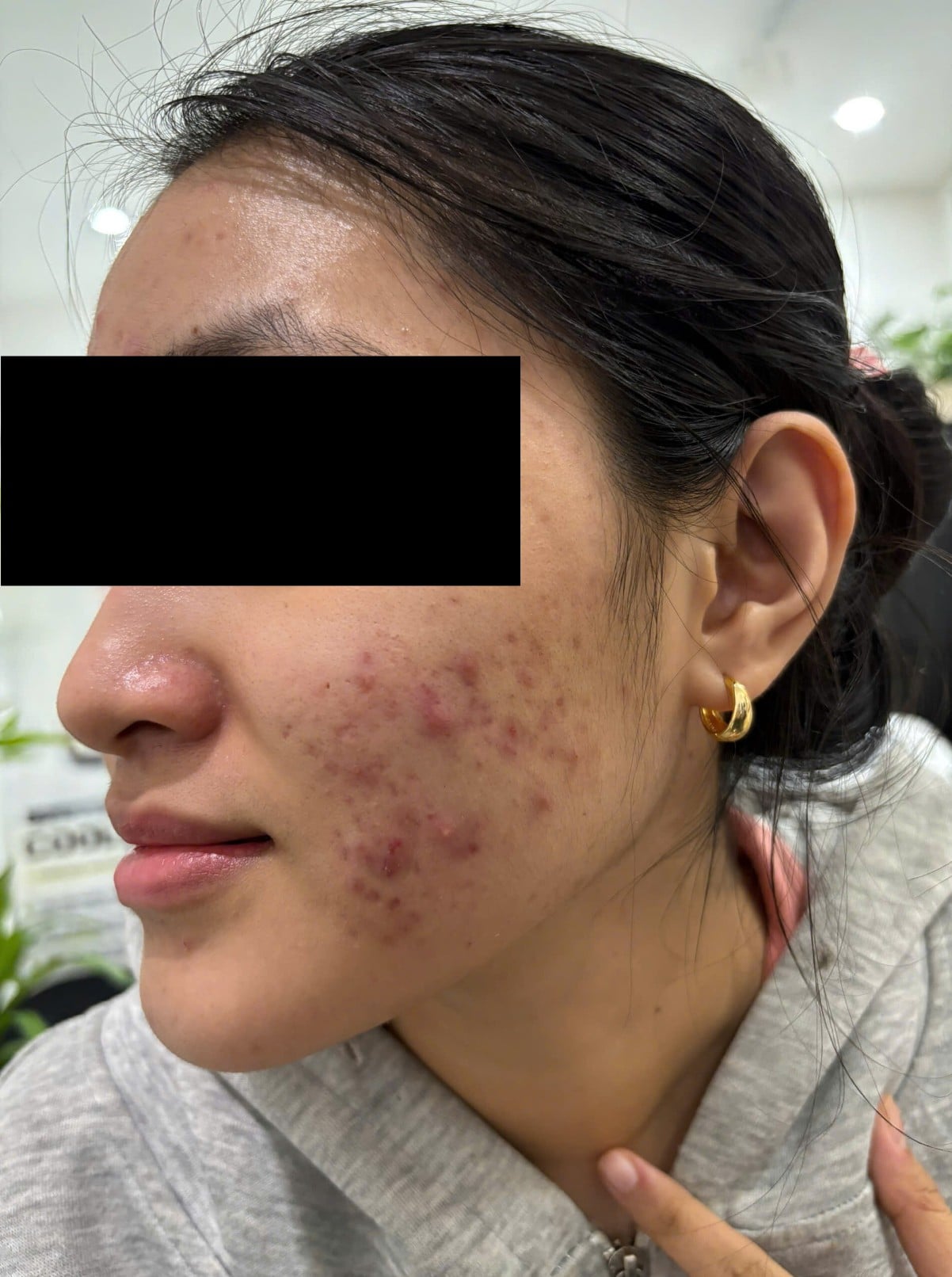 Sau điều trị tại MediSkin Long An